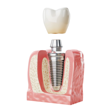 teeth-crown