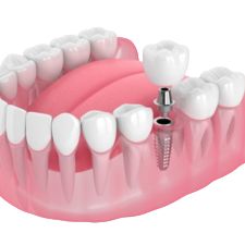teeth-imlement-bgremove